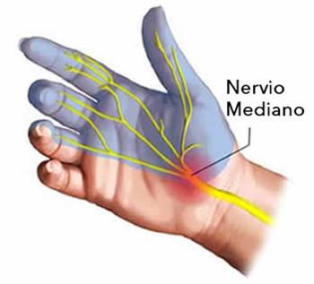 nervio mediano tunel carpiano