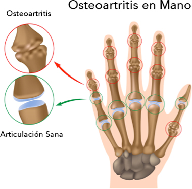 osteoartritis