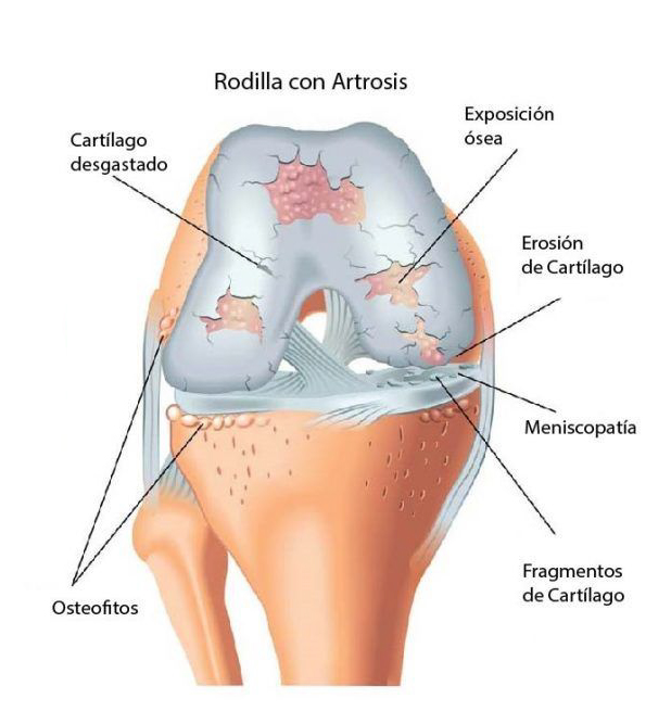 Artrosis de Rodilla