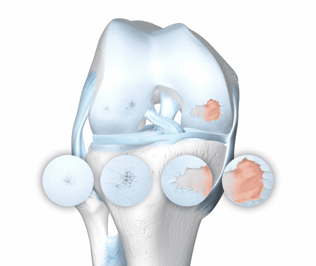 Ilustración anatómica de rodilla con lesiones progresivas del cartílago asociadas a artrosis