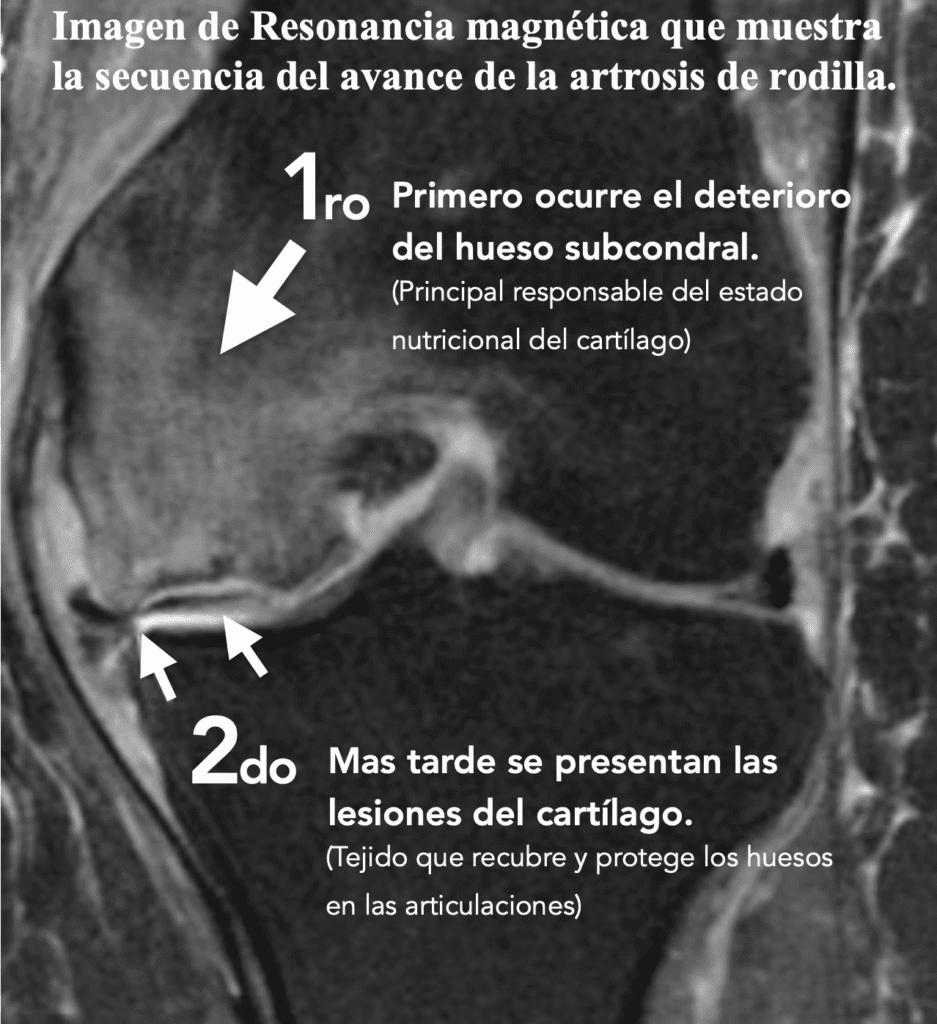 Resonancia magnética de rodilla con edema óseo subcondral señalado por una flecha en paciente con artrosis