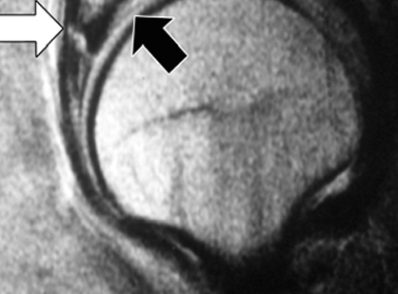 Pinzamiento-femoroacetabular-10